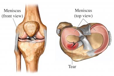 an illustration of a knee joint with a tear in the muscle